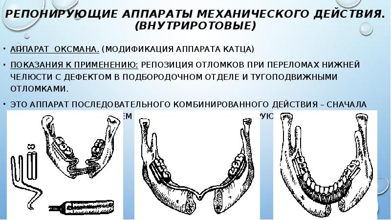 Протезирование после резекции верхней челюсти презентация