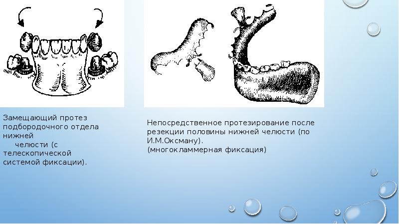 Протезирование после резекции верхней челюсти презентация