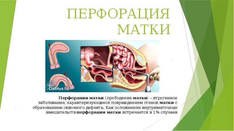 ПЕРФОРАЦИЯ МАТКИ
Перфорация матки (прободение матки) – ятрогенное заболевание, характеризующееся повреждением стенок матки с образованием ПЕРФОРАЦИЯ МАТКИ
Перфорация матки (прободение матки) – ятрогенное заболевание, характеризующееся повреждением стенок матки с образованием