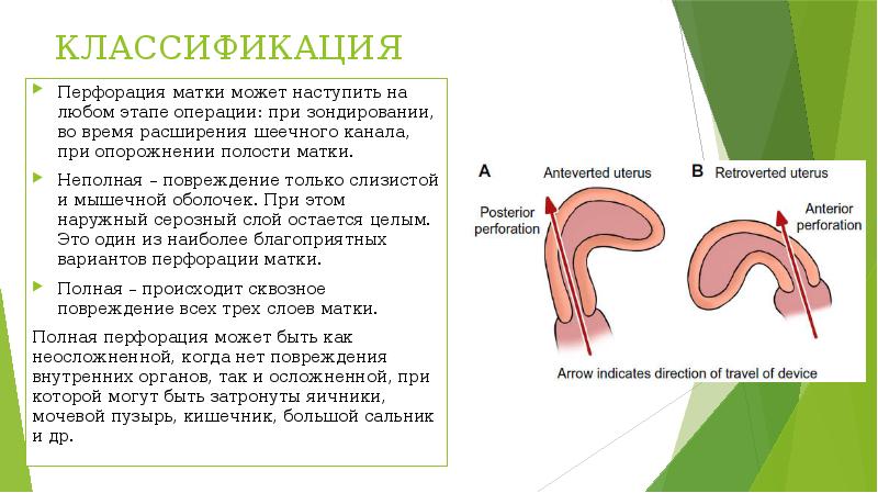 КЛАССИФИКАЦИЯ
Перфорация матки может наступить на любом этапе операции: при зондировании, КЛАССИФИКАЦИЯ
Перфорация матки может наступить на любом этапе операции: при зондировании,