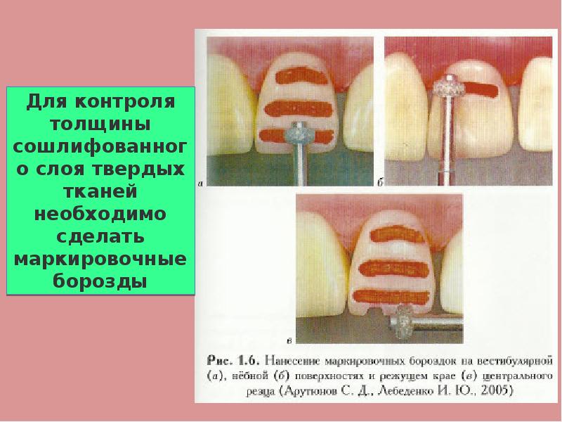 Препарирование под коронки презентация