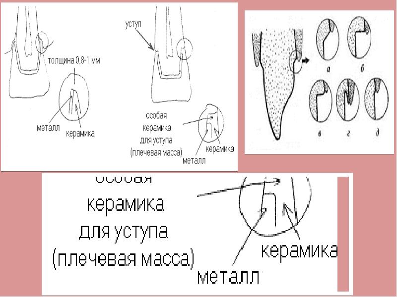 Штампованная коронка препарирование