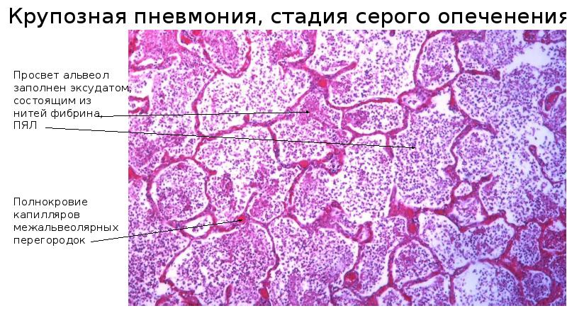 Крупозная пневмония патологическая анатомия презентация