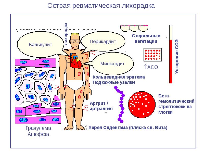 Острая ревматическая лихорадка презентация терапия