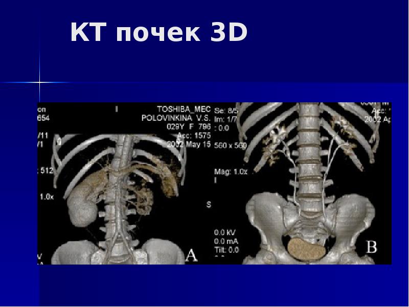 Кт почек презентация