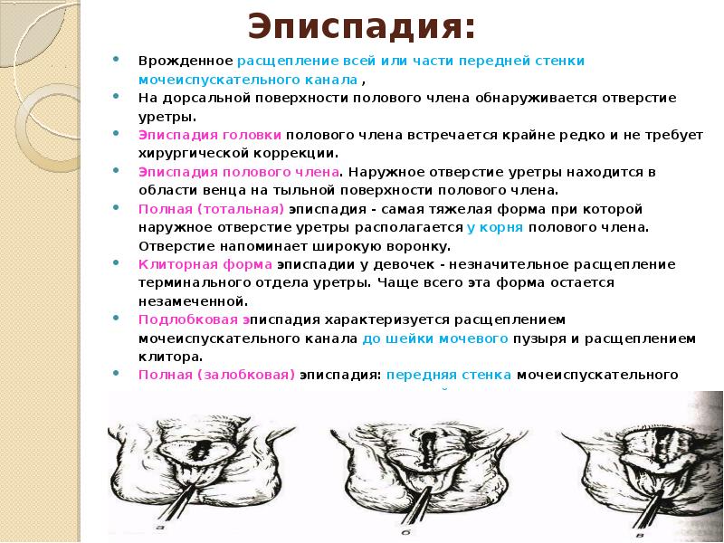 Аномалии развития мочеиспускательного канала презентация