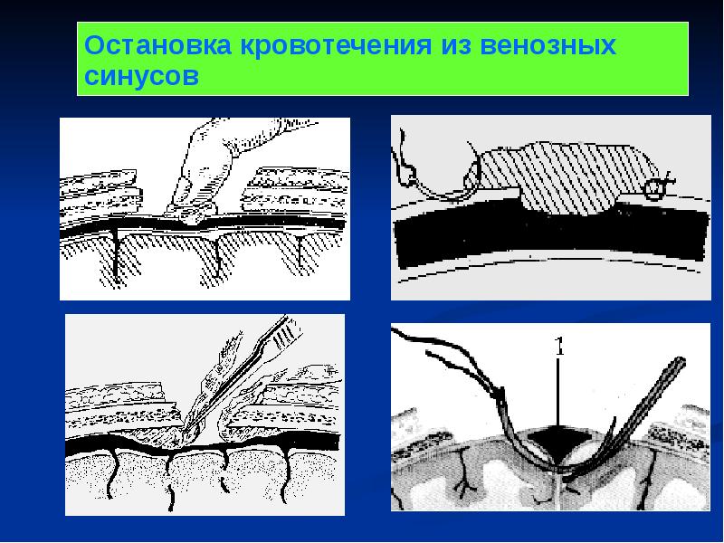 Операции на мозговом отделе головы презентация