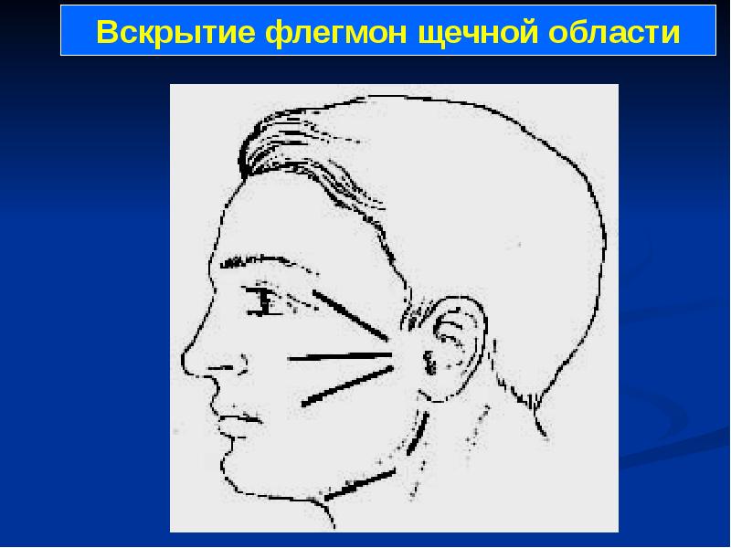 Подразделение головы. Вскрытие флегмоны щечной области. Разрезы при флегмоне щечной области. Разрезы при флегмонах лица. Вскрытие флегмоны головы.