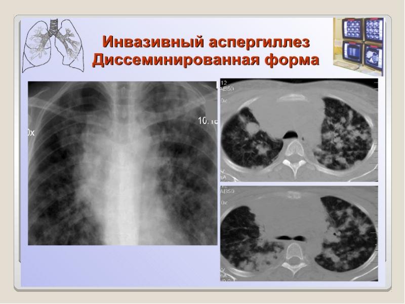 Аллергический бронхолегочный аспергиллез презентация