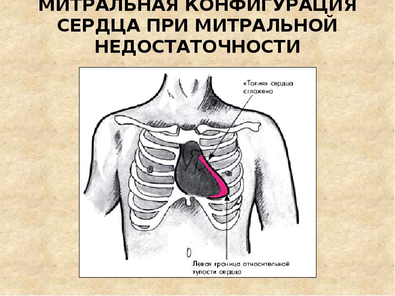 Конфигурация сердца. Митральная конфигурация сердца. Митральная конфигурация сердца границы. Митральная и аортальная конфигурация сердца. Конфигурация сердца при сердечной недостаточности.