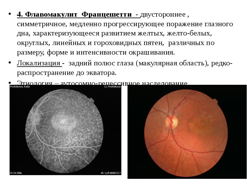 Пигментный ретинит презентация