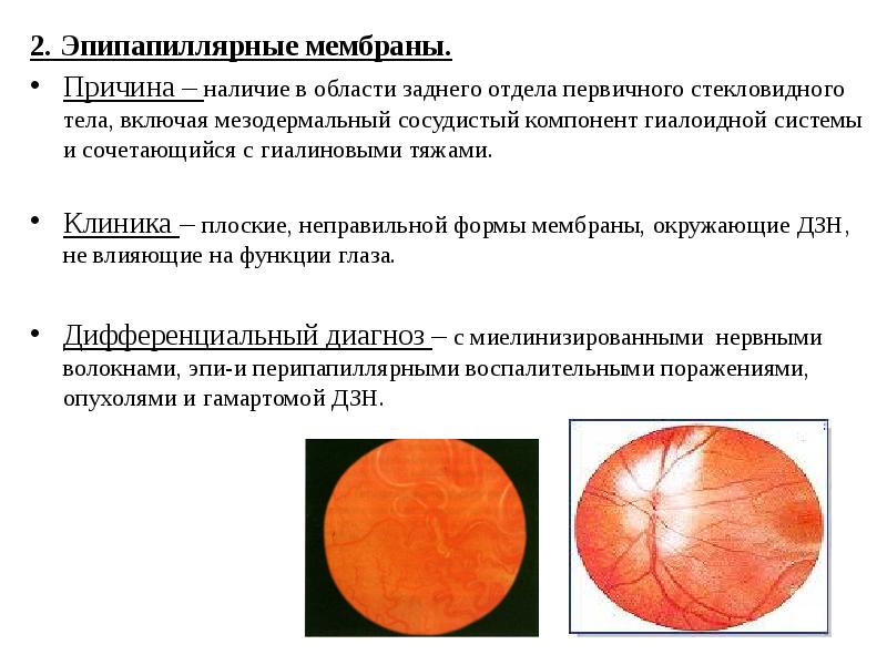 Заболевания органов зрения презентация