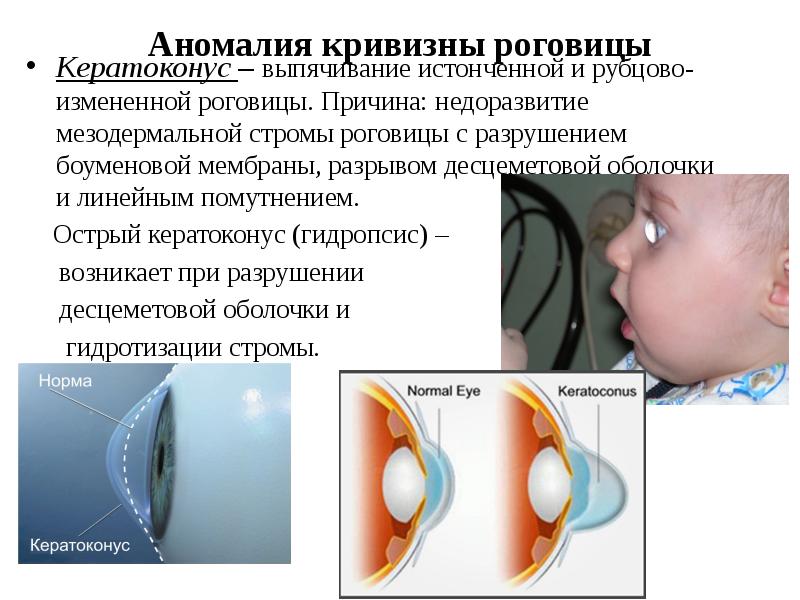 Презентация на тему кератоконус