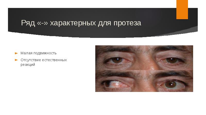 Отсутствие естественно. Исследование подвижности глазного протеза. Ряд «-» характерных для протеза глаза.