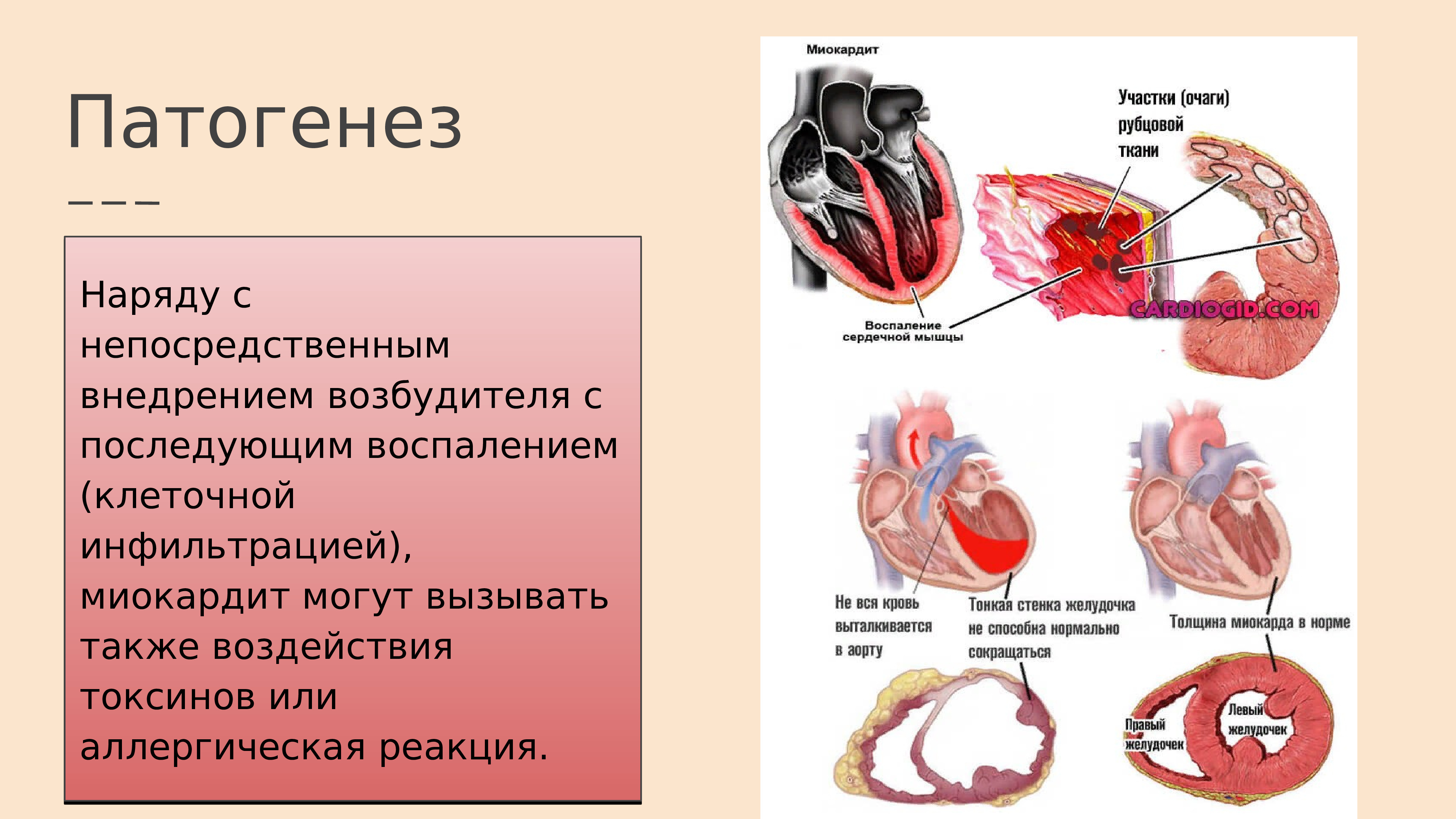 Миокардит картинки для презентации