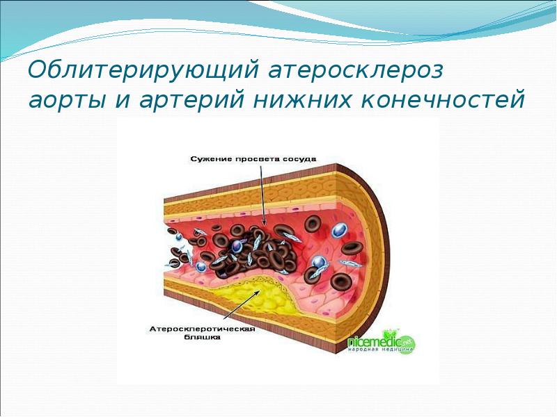 Острая артериальная непроходимость нижних конечностей презентация