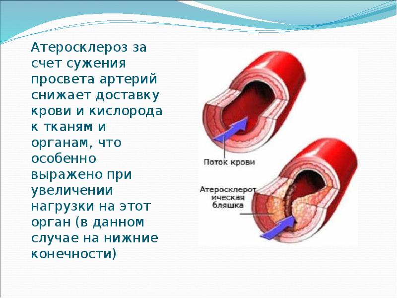 Как изменяется просвет артерий