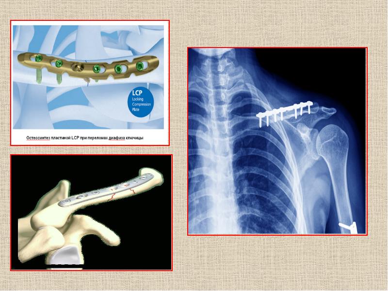 Лечение переломов и вывихов презентация