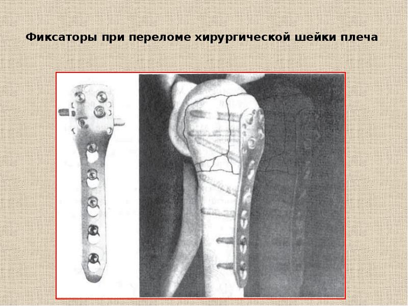 Перелом хирургической шейки плеча