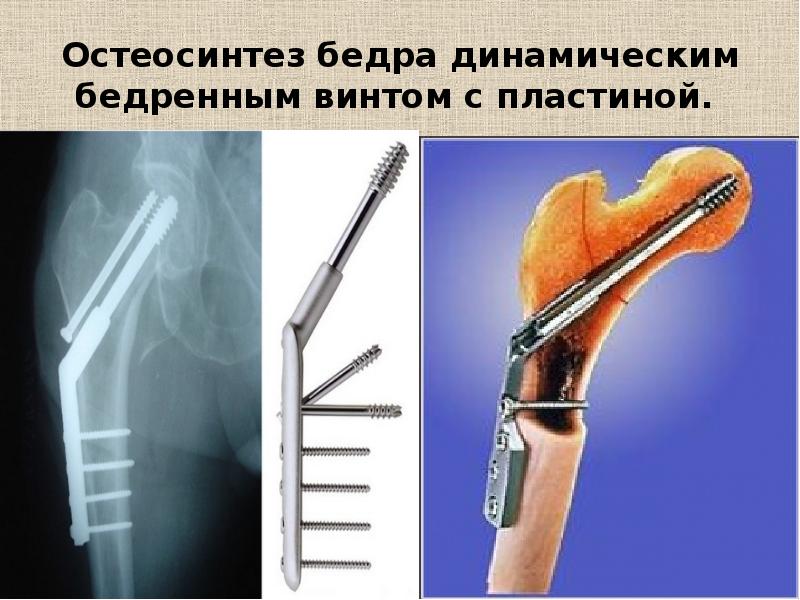 Лечение переломов и вывихов презентация