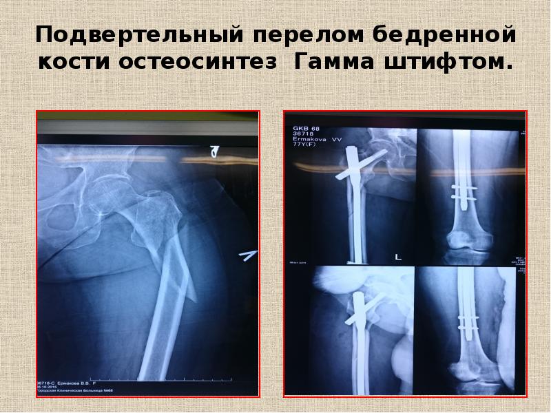 Переломы бедра презентация