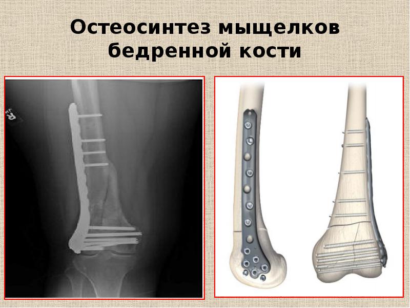 Лечение переломов и вывихов презентация