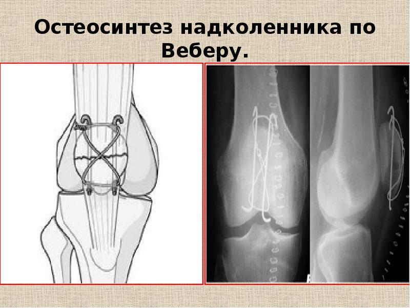 Лечение переломов и вывихов презентация