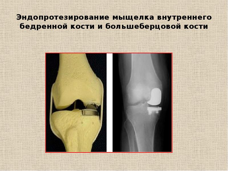 Контузионные изменения кости. Мыщелки коленного сустава. Перелом наружной мыщелка бедренной кости. Перелом внутреннего мыщелка большеберцовой кости. Импрессионный перелом мыщелка бедренной кости кости.