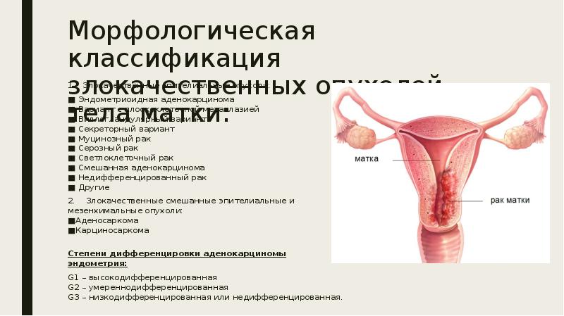 Презентация опухоли маточных труб