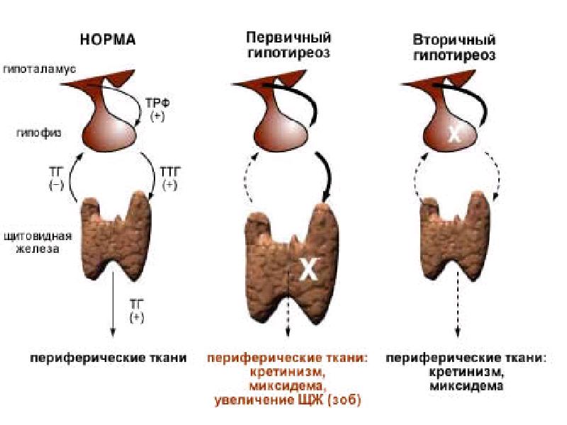 Гипофункция щитовидной железы. Гипотиреоз первичный вторичный третичный. Первичный врожденный гипотиреоз. Первичные и вторичные заболевания щитовидной железы. Врожденный гипотиреоз патогенез.