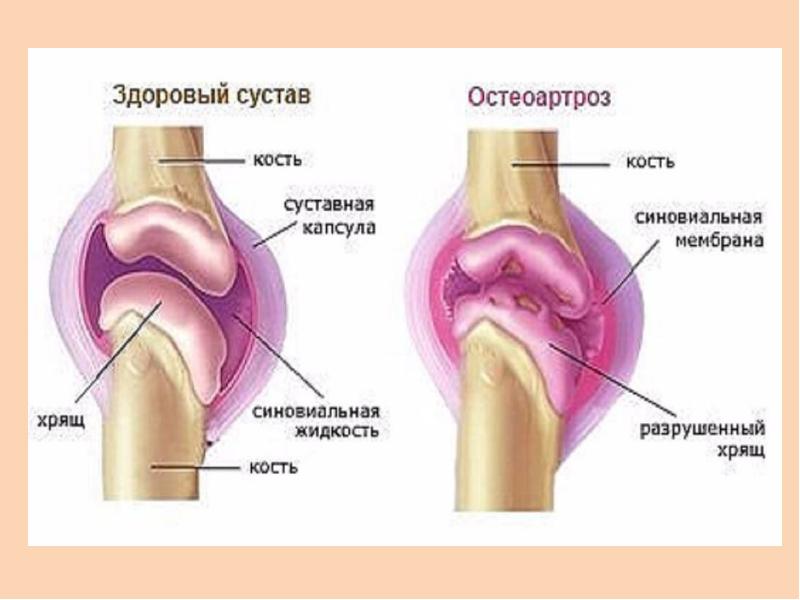 Суставы болят лечение. Остеоартроз суставов народными средствами. Синовиальная жидкость при остеоартрозе. Препараты при доа колена.