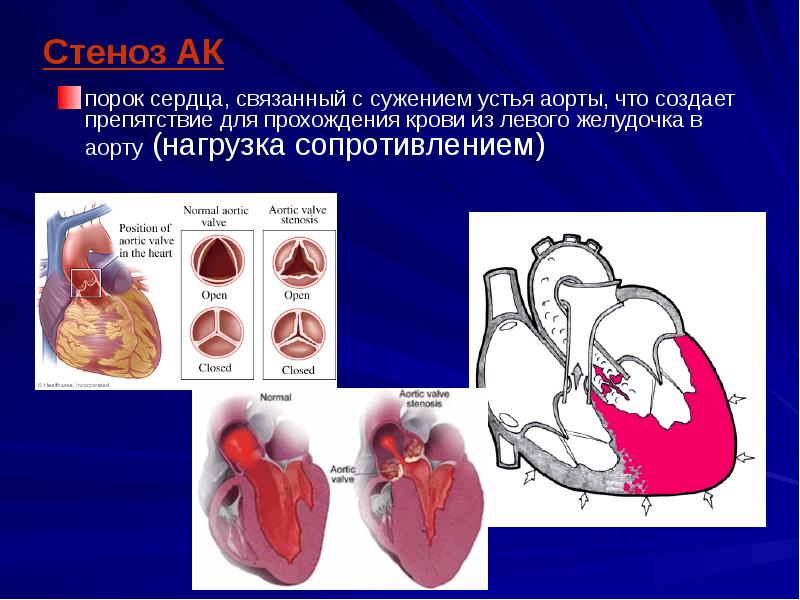 Как выглядит порок сердца на картинке