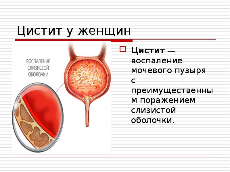 Цистит у женщин Цистит&nbsp;— воспаление мочевого пузыря с преимущественным поражением слизистой