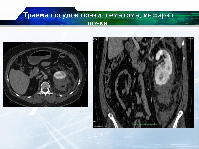 Аномалии почек презентация