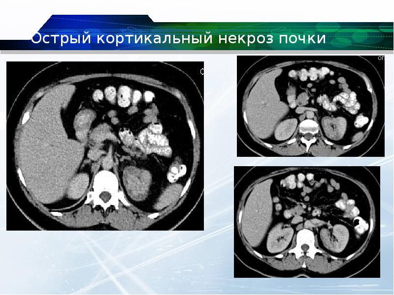 Кт картина са левой почки