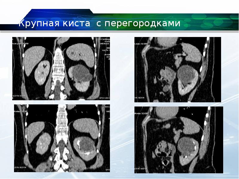 Кисты почек презентация