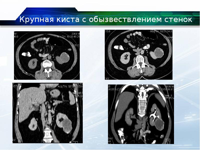 Уплотнение стенок чашечно лоханочной системы почек