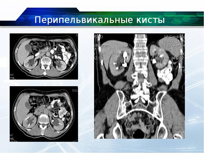 Парапельвикальные кисты почек: признаки и способы …