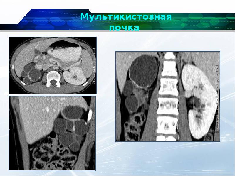 Дисплазия почки презентация