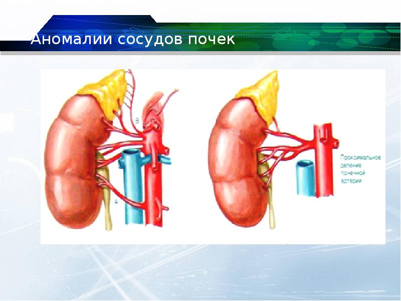 Аномалии развития почки картинки