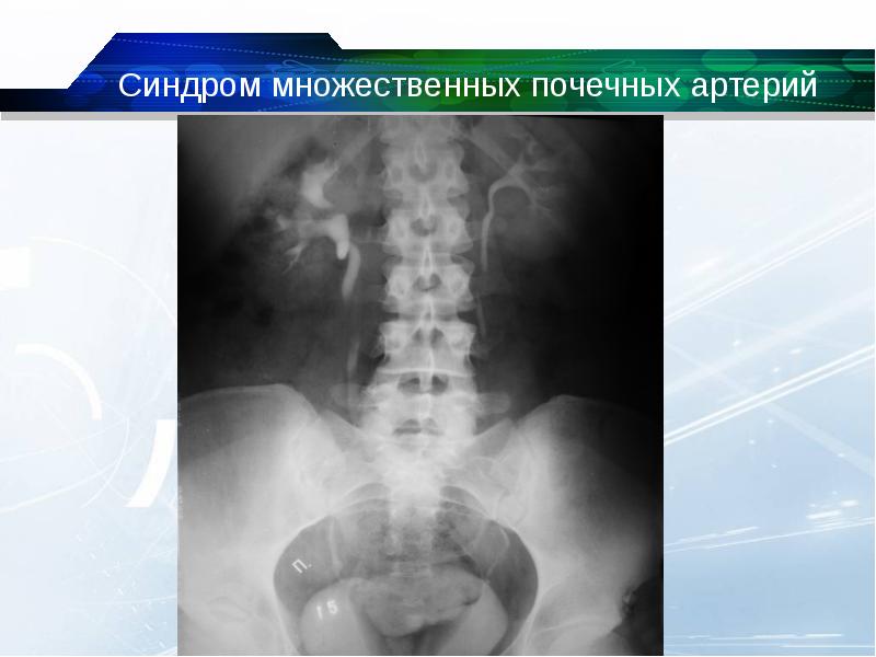 Аномалии почек презентация