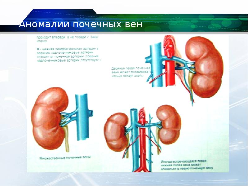 Аномалии почек презентация