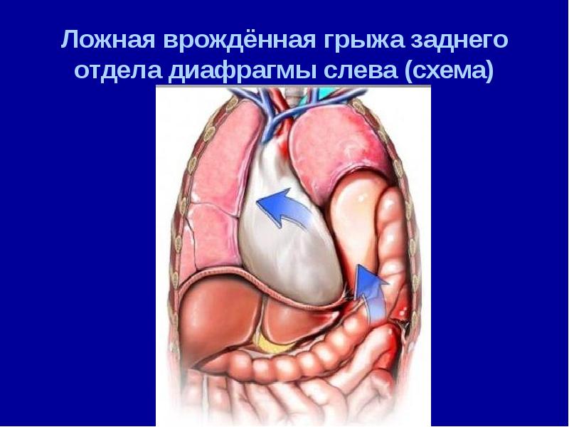 Диафрагмальная грыжа. Врожденная ложная диафрагмальная грыжа. Диафрагмальная грыжа слева. Ложные грыжи диафрагмы. Истинная диафрагмальная грыжа.