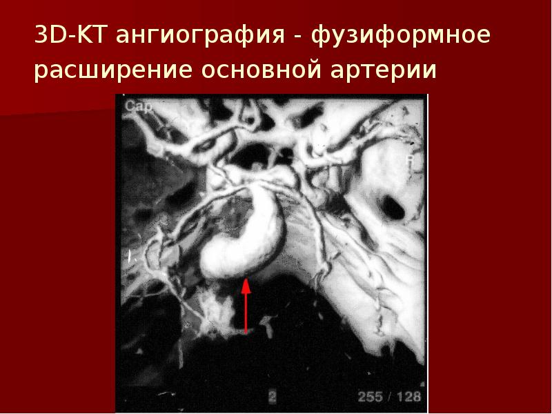 Мешотчатые аневризмы вса. Фузиформное расширение внутренней сонной артерии кт. Фузиформная аневризма головного мозга. Фузиформное расширение основной артерии. Фузиформная аневризма основной артерии.