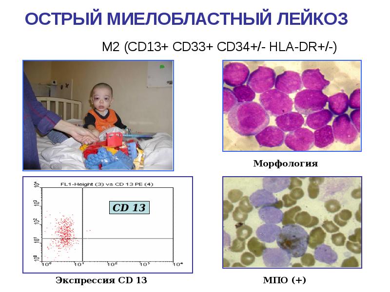 Лейкоз у детей презентация