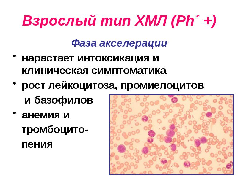 Лейкоз у детей презентация