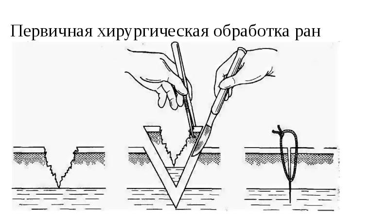 Раны хирургия презентация