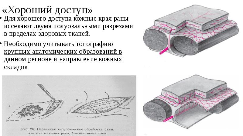 Первичная хирургическая обработка раны презентация