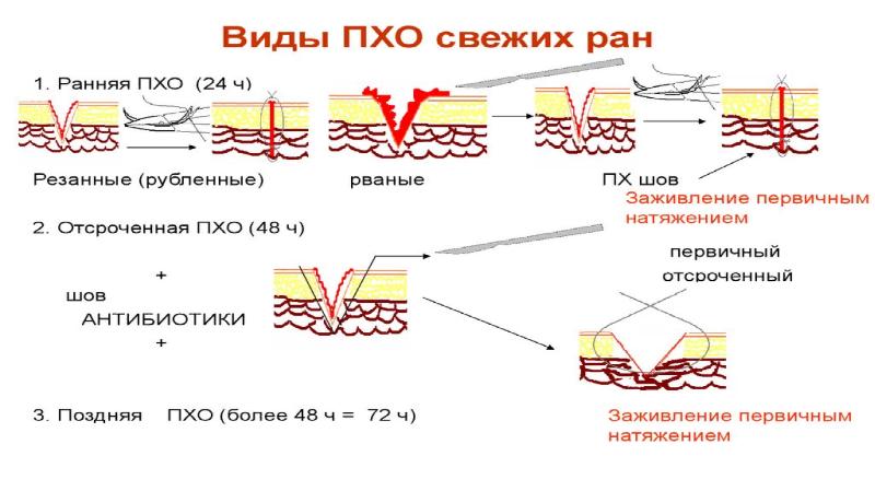 Первичная хирургическая обработка раны презентация