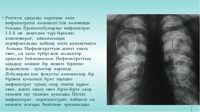 Перисциссурит рентген картина